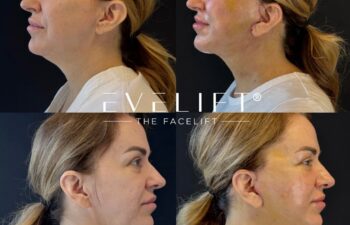 female patient before and after EVELIFT®