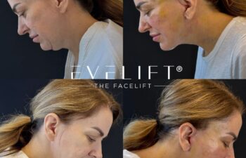 female patient before and after EVELIFT®