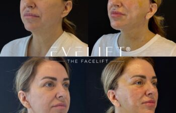 female patient before and after EVELIFT®