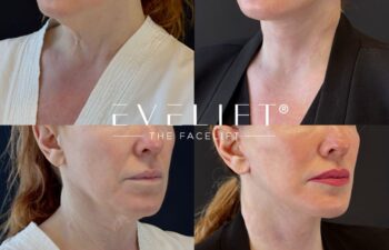 female patient before and after EVELIFT®