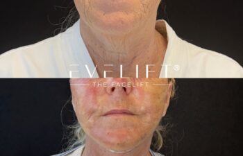 female patient before and after EVELIFT®