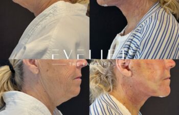 female patient before and after EVELIFT®
