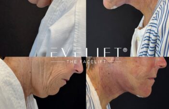 female patient before and after EVELIFT®