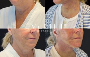female patient before and after EVELIFT®