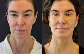 female patient before and after EVELIFT®