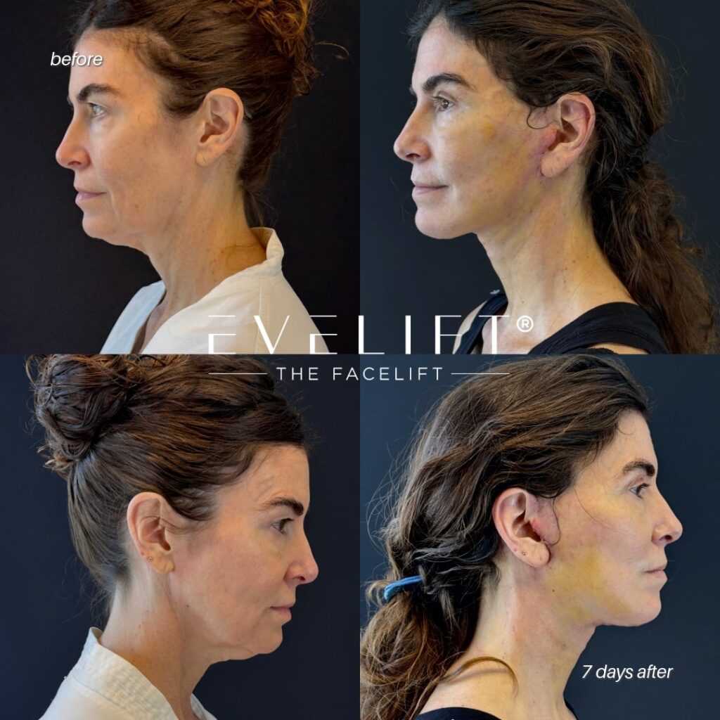 female patient before and after EVELIFT®