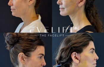female patient before and after EVELIFT®
