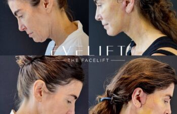 female patient before and after EVELIFT®