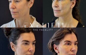 female patient before and after EVELIFT®