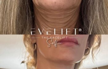female patient before and after EVELIFT®