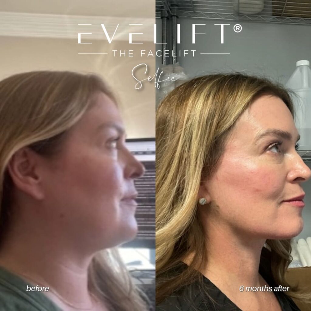 female patient before and after EVELIFT®