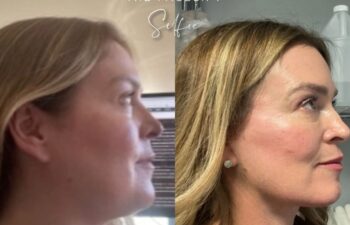 female patient before and after EVELIFT®
