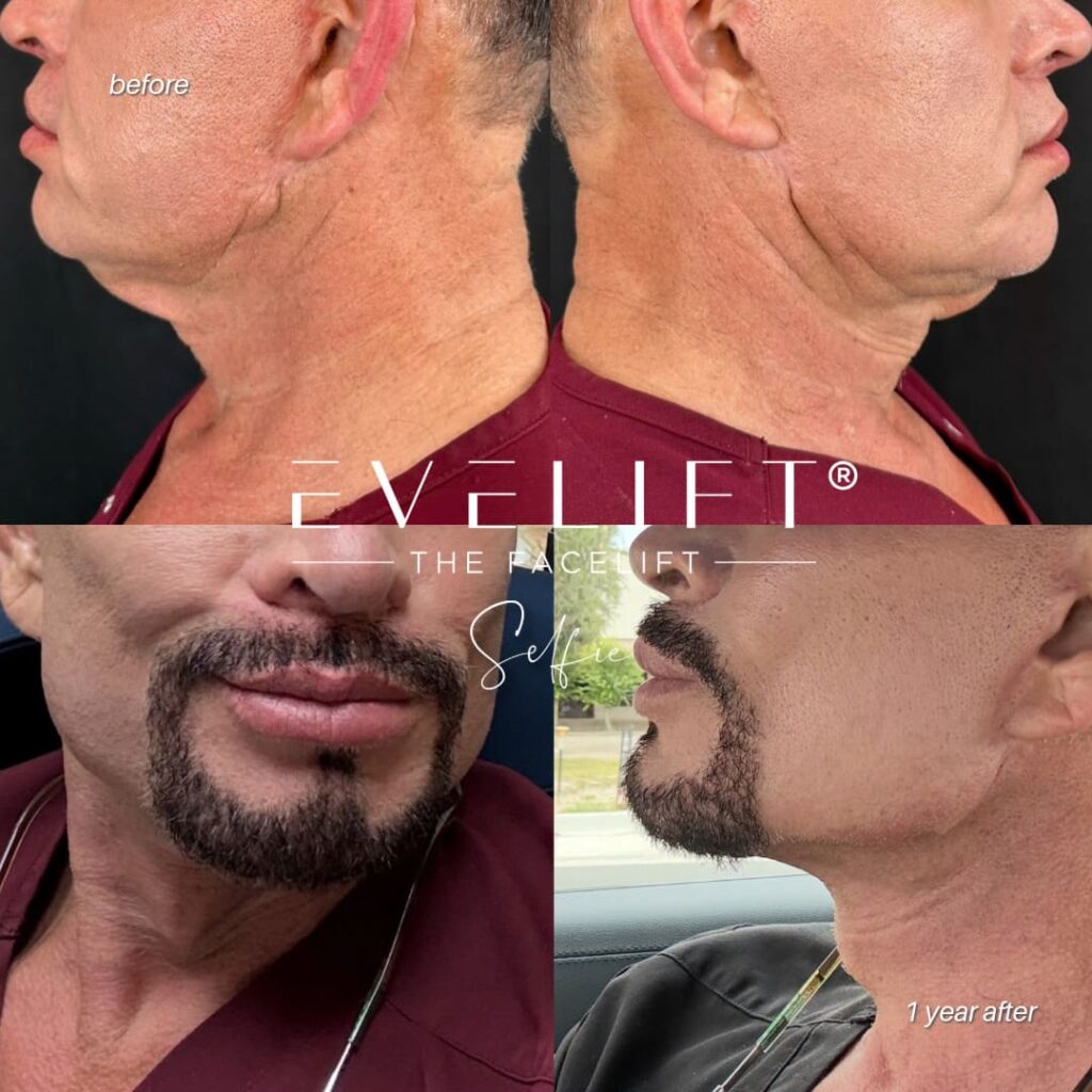 male patient before and after EVELIFT®