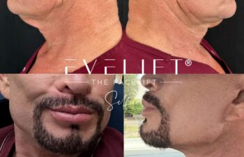 male patient before and after EVELIFT®