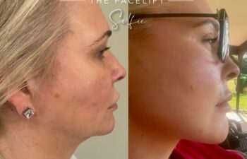 female patient before and after EVELIFT®