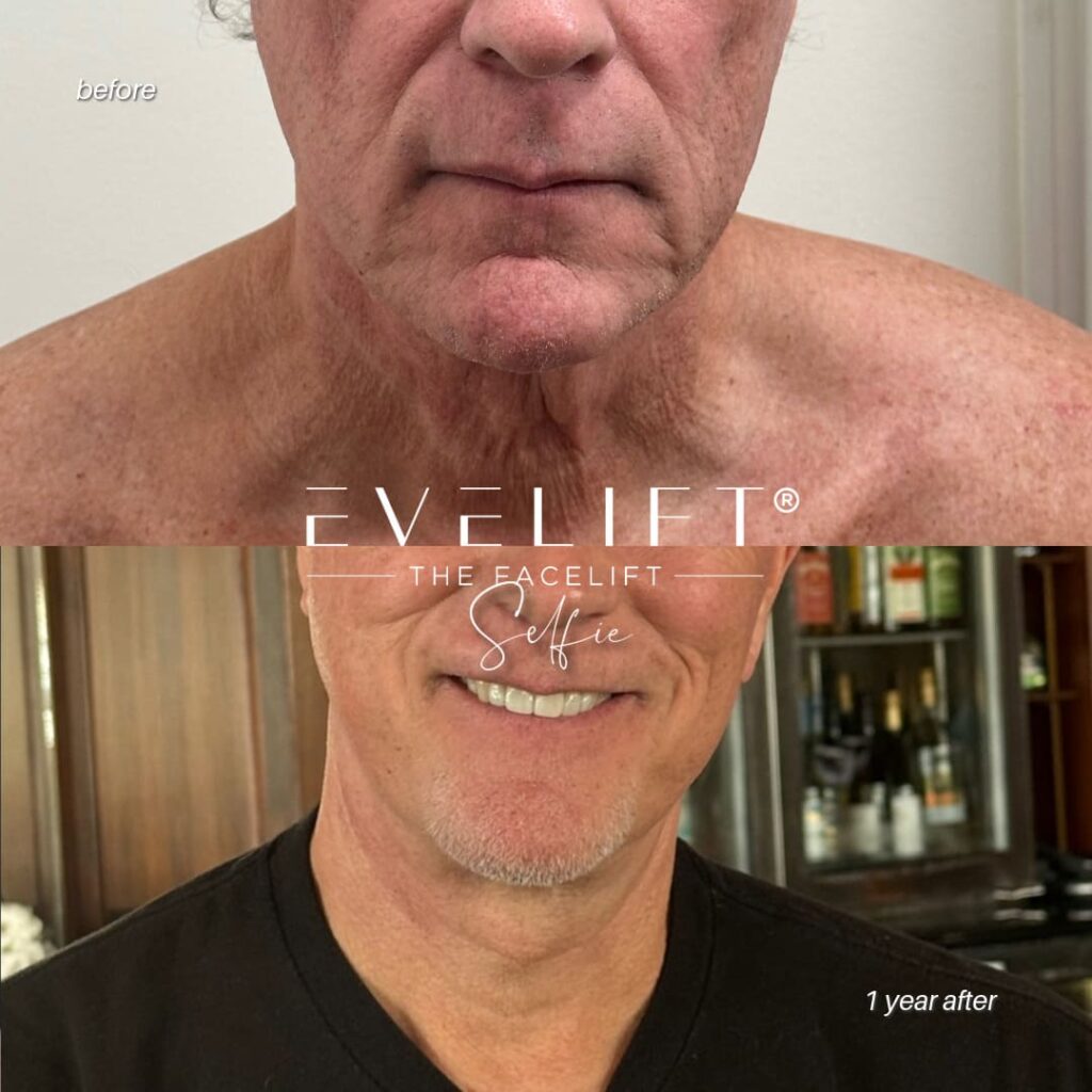 male patient before and after EVELIFT®