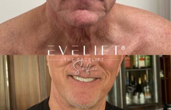 male patient before and after EVELIFT®