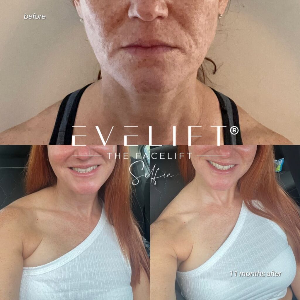 female patient before and after EVELIFT®