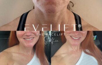female patient before and after EVELIFT®