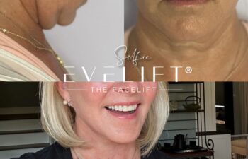 female patient before and after EVELIFT®