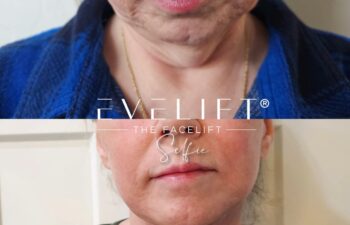 female patient before and after EVELIFT®