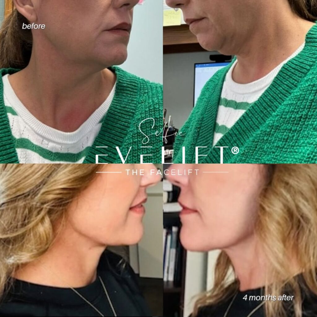 female patient before and after EVELIFT®