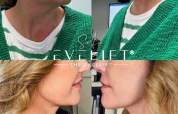 female patient before and after EVELIFT®