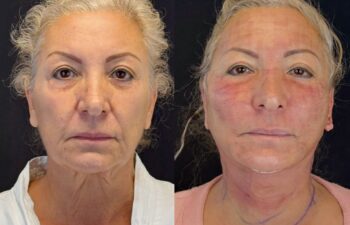 female patient before and after EVELIFT®