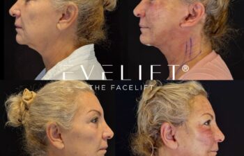 female patient before and after EVELIFT®