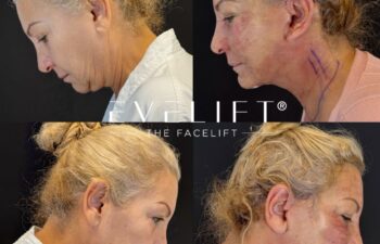 female patient before and after EVELIFT®