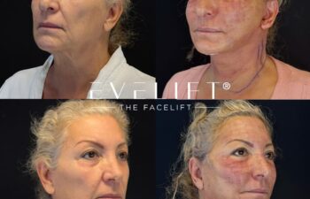female patient before and after EVELIFT®