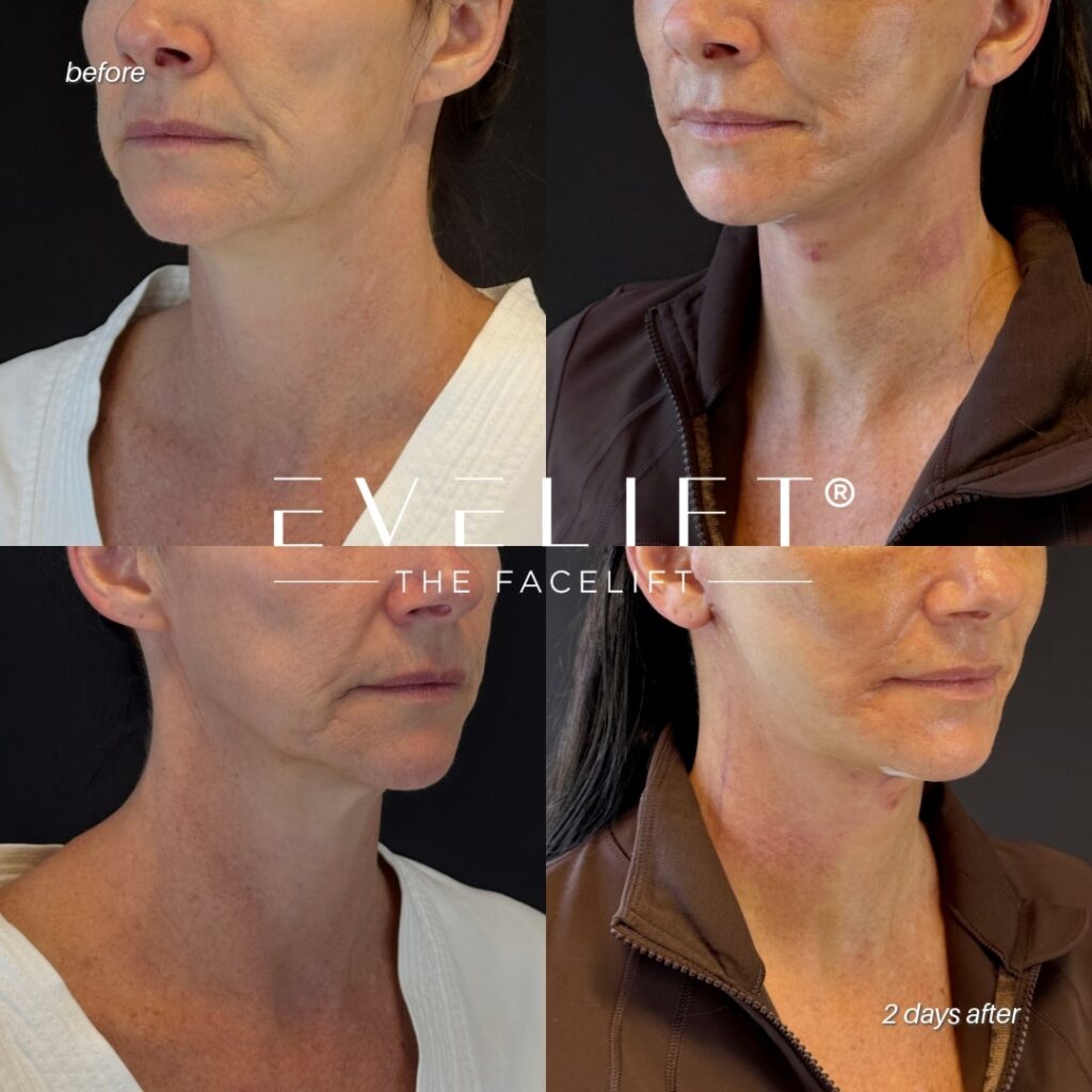 female patient before and after EVELIFT®