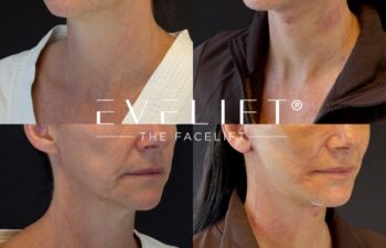female patient before and after EVELIFT®