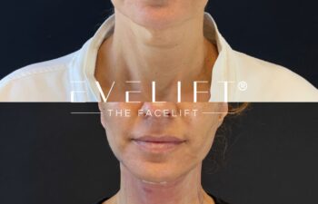 female patient before and after EVELIFT®