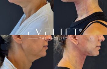 female patient before and after EVELIFT®