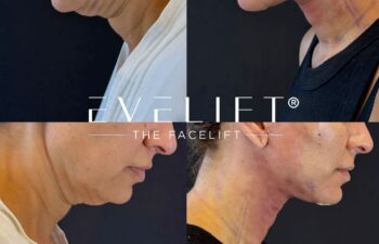 female patient before and after EVELIFT®