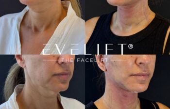 female patient before and after EVELIFT®