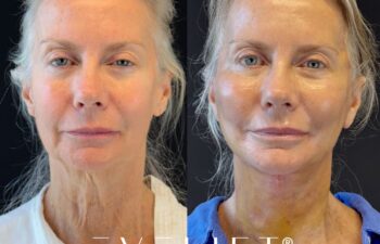 female patient before and after EVELIFT®