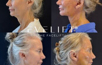 female patient before and after EVELIFT®