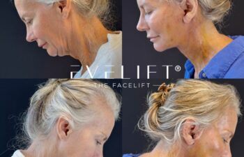female patient before and after EVELIFT®