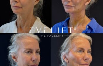 female patient before and after EVELIFT®