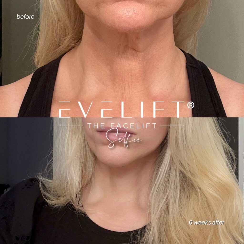female patient before and after EVELIFT®