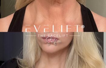 female patient before and after EVELIFT®