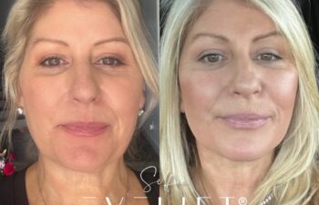 female patient before and after EVELIFT®