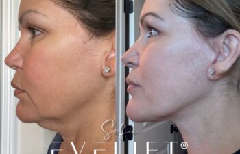 female patient before and after EVELIFT®