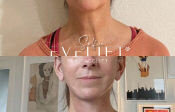 female patient before and after EVELIFT®