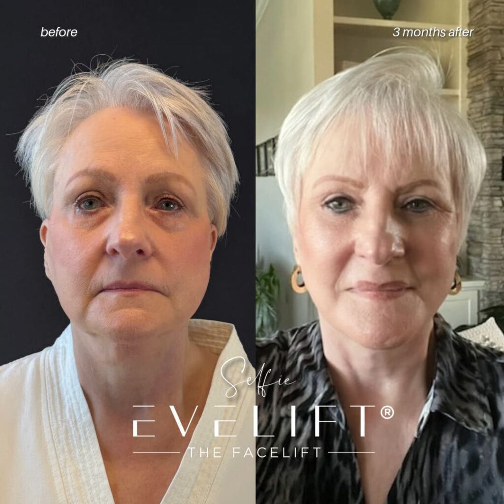 female patient before and after EVELIFT®