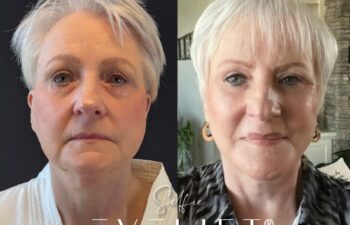 female patient before and after EVELIFT®
