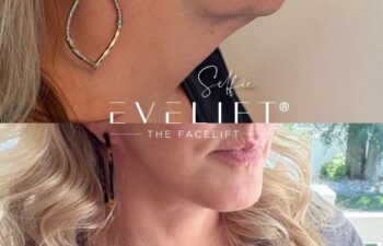 female patient before and after EVELIFT®
