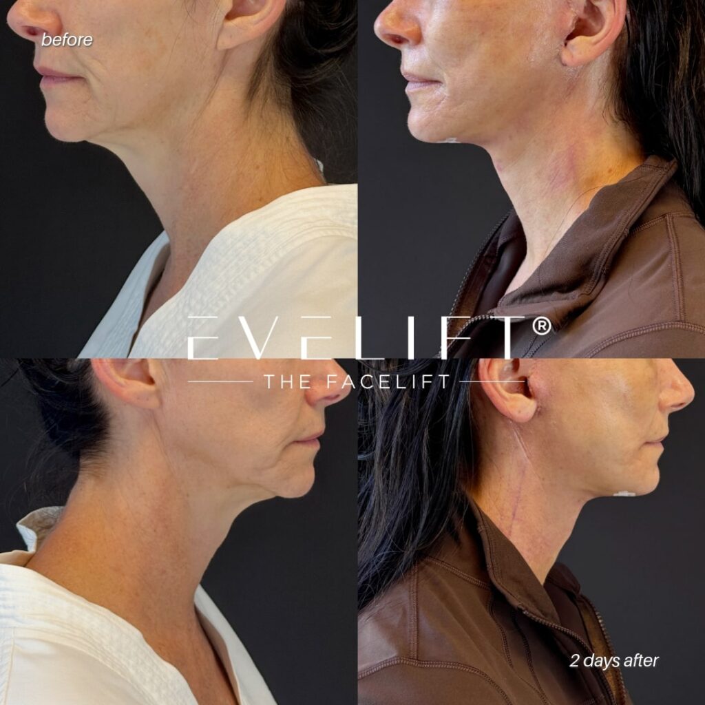 female patient before and after EVELIFT®